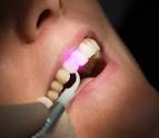 Parodontite Laser Costi e Prezzi per seduta