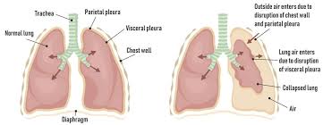 Image result for Pneumothorax