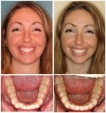 Dr Ginger Price Elite Invisalign Provider Before And After Photos Ph 602 468 1135 Www Gingerpricedds Com Dental Veneers Dental Cosmetic Dentistry
