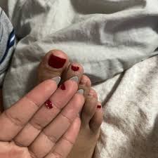 Image result for Clubbing nails feet