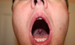 One large lymph node (more than three centimeters in size) on the same side of the neck as the tumor, multiple lymph nodes of. Persistent Sore Throat Can Be A Sign Of Cancer According To Study