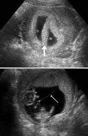 What To Expect When You Re Expecting Twins Or More Your Pregnancy Matters Ut Southwestern Medical Center