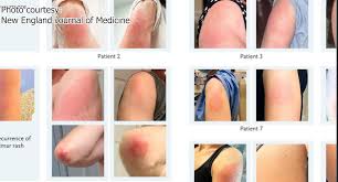 What exactly is 'covid arm'? Doctor Explains Covid Arm What It Is What To Do If You Get It