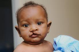 Meet Omar from Somalia! 🇸🇴 Born with a cleft, his journey began with  challenges, but thanks to Smile Train and Kalkaal Hospital, he received the  care he needed early on. “After my