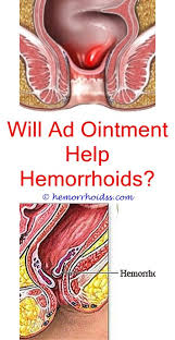 Pin On Hemorrhoid Banding