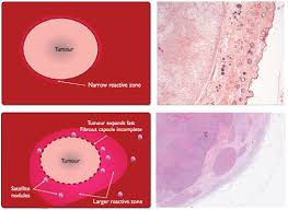 There can be other areas but this is good news. Soft Tissue Sarcoma In The Dog Part 2 Surgical Margins Controversies And A Comparative Review Bray 2017 Journal Of Small Animal Practice Wiley Online Library