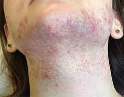 (i'm partly southern italian with robust hair follicles—what can i say?) obviously the kid was a jerk and there's nothing wrong with body hair, but the fact remained that as i. Logic A Fi Surprins Urs Panda Ipl Laser Hair Removal Reviews Jadefitzgeraldcomedy Com