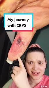 CRPS Awareness Month: My Journey with Chronic Illness