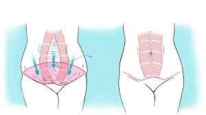 Tummy tuck procedure (Abdominoplasty) — My Plastic Surgeon