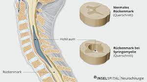 Syringomyelie