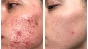 The Exact Skincare Products That Helped Clear This Woman S Cystic Acne In Just 3 Months Cerave Moisturizer Skin Care Cystic Acne