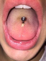 Zungenpiercing Nach 3 Tagen Eiter Piercing Entzundung Zunge