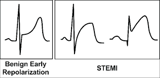 Image result for Early Repolarization