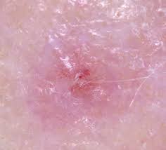 Pin On Melanoma