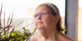 Are 1000-Lb Sisters' Tammy's Skin Removal Surgery Results Too Extreme?  (Facts About The Facelift)