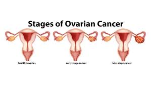 Selain kanker payudara, jenis kanker lainnya yang bikin gentar kaum hawa adalah kanker ovarium dan kanker serviks. Risiko Gejala Pemeriksaan Dan Pengobatan Kanker Ovarium Rs Kanker Fuda