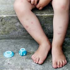 Bug Bites That Look Like Mosquito Bites But Aren T Treating Mosquito Bites In Kids Treating Mosquito Bites Remedies For Mosquito Bites Prevent Mosquito Bites