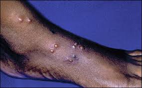 Image result for Papular urticaria