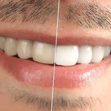 Image result for Tooth Discoloration
