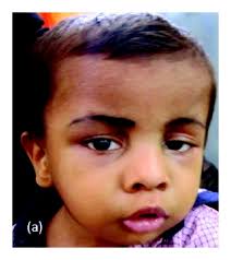 Proband 1 with Emanuel syndrome: (a) phenotype with unilateral left...