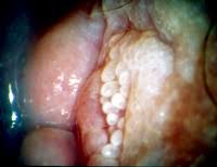 Micropapillomatosis Vulvae – A Fatal Misdiagnosis