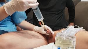 small bladder enema, large syringe, catheter, from my home nurse