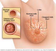 Bengkak susu memang menyakitkan, bengkak susu selepas bersalin boleh menyebabkan demam cara mengatasi dan petua. Cara Atasi Saluran Susu Tersumbat Pada Payudara Ibu Menyusu Elak Bahaya Mastitis