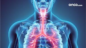 Some people may experience nosebleeds. Stage 4 Throat Cancer Metastatic Throat Cancer Onco Com