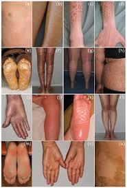 Image result for Ichthyosis