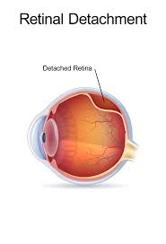 Most retinal breaks, holes, or tears are not a result of injury. Retinal Detachment Laser Photocoagulation Surgery Beverly Hills Ca