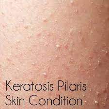Keratosis Pilaris Bumps On Skin Babywise Mom Skin Bumps Rough Bumpy Skin Keratosis Pilaris