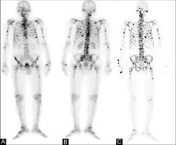 Although the percentage of cases in men is much lower than in women, male breast cancer accounts for a por. A C A 76 Year Old Man Presented With Metastatic Prostate Carcinoma Download Scientific Diagram
