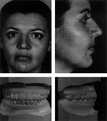 The Long Face Syndrome and Rhinoplasty