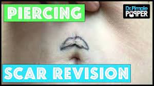 Scar Revision After A Bad Belly Button Piercing Youtube