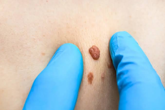 Removing Skin Tags: What You Need to Know - Freyja Medical