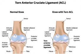 When the other knee ligaments are too weak to support the new acl, this causes acl surgery failure. How Will I Recover From Acl Surgery Long Pond Physical Therapy Plymouth And Pembroke