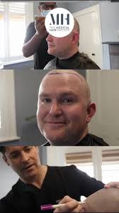 🎥 Matt Shares His NeoGraft Hair Transplant Journey 🎥, Curious about what  it’s like to undergo a hair transplant? Hear directly from our patient Matt  as he shares his experience, results, and how it’s ...