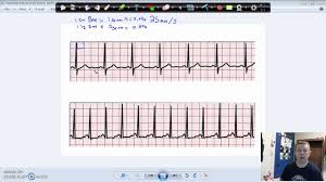 How to calculate heart rate from ecg. Calculate Heart Rate From An Ecg Youtube
