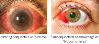 עם bloodshot eyes bare dreams ו loyal panic! Eye Redness