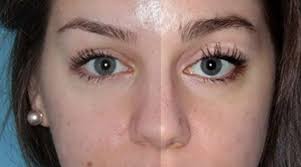 Many people, especially women, desire to have thicker and longer eyelashes. How To Use Latisse