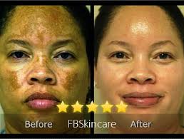 Black And White Bleaching Cream With Hydroquinone Amazon Pin On Skincare