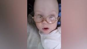 Formerly conjoined twin Carter remains in hospital for now
