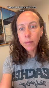 One of my clients had ongoing inflammatory issues — tendon pain, swelling,  discomfort — and her vitamin D levels were sitting around 25–30 ng/mL  (that’s ~60–75 nmol/L here in NZ). Low., She started ...