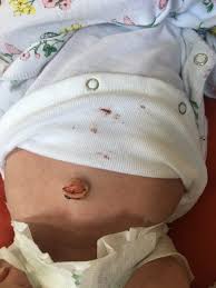 There's no need to give your newborn a bath every day. Belly Button Still Bleeding March 2019 Babies Forums What To Expect