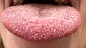 Image result for Puchýře na jazyku