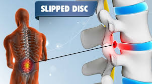 Tu slip keputusan peperiksaan arwah adik saya. Slipped Disc Maksud Lengkap Punca Cara Atasi Claim Perkeso