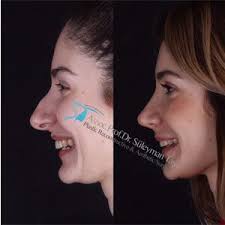Rhinoplasty Gallery Assoc Prof Dr Suleyman Tas Rhinoplasty Nose Job Rhinoplasty Nose Jobs