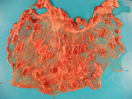 Image result for Q Fever