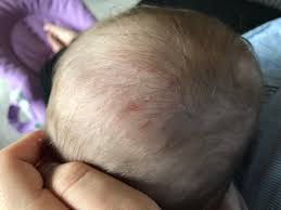 Image result for dry scabs on the head in children