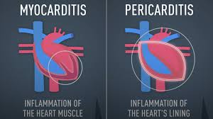 Myocarditis is the inflammation of the heart muscle, while pericarditis is the inflammation of the membrane surrounding the heart. Can Covid 19 Damage The Heart Even In Asymptomatic Patients Cgtn